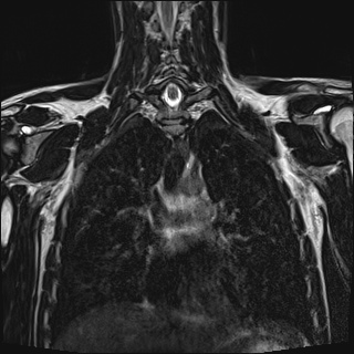 Bilateral spinoglenoid notch ganglion cysts (Radiopaedia 29577-30082 Coronal T2 66).jpg