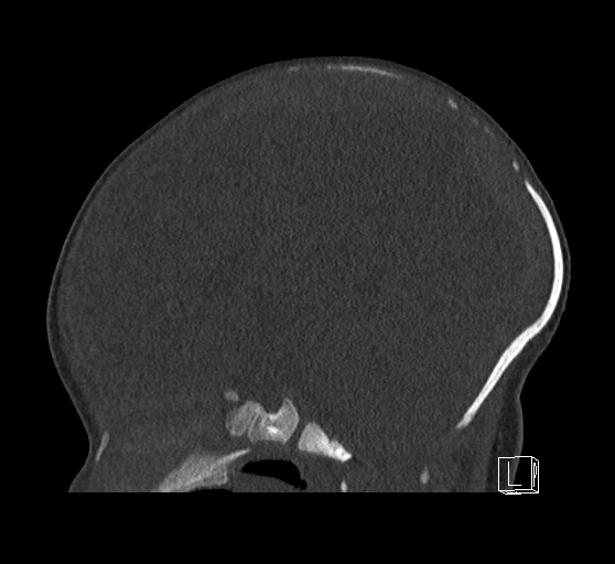 File:Bilateral subdural hemorrhage and parietal skull fracture (Radiopaedia 26058-26192 Sagittal bone window 50).png