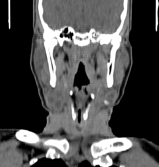 Bilateral submandibular sialolithiasis with sialadenitis (Radiopaedia 70721-80881 Coronal non-contrast 56).jpg