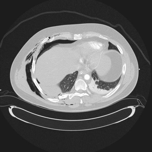 Bilateral traumatic renovascular injury (Radiopaedia 32051-32995 Coronal lung window 1).jpg