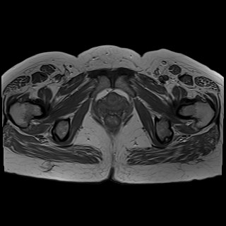 Bilateral tubo-ovarian abscesses (Radiopaedia 58635-65829 Axial T1 C+ 43).jpg