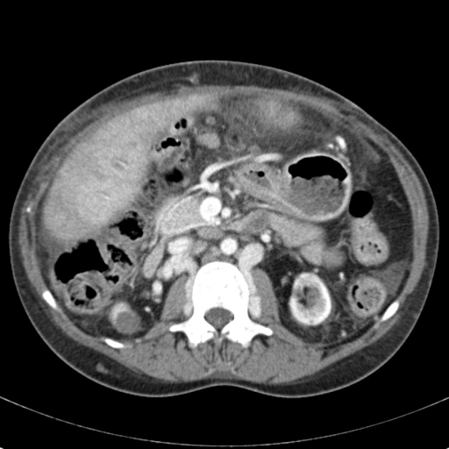 Biliary necrosis - liver transplant (Radiopaedia 21876-21846 B 32).jpg
