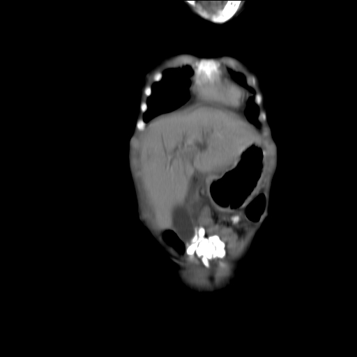 File:Biliary tract embryonal rhabdomyosarcoma (Radiopaedia 51815-57648 B 4).jpg