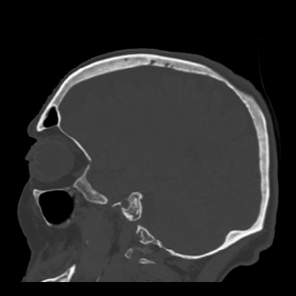 Biparietal osteodystrophy (Radiopaedia 46109-50463 Sagittal bone window 37).jpg