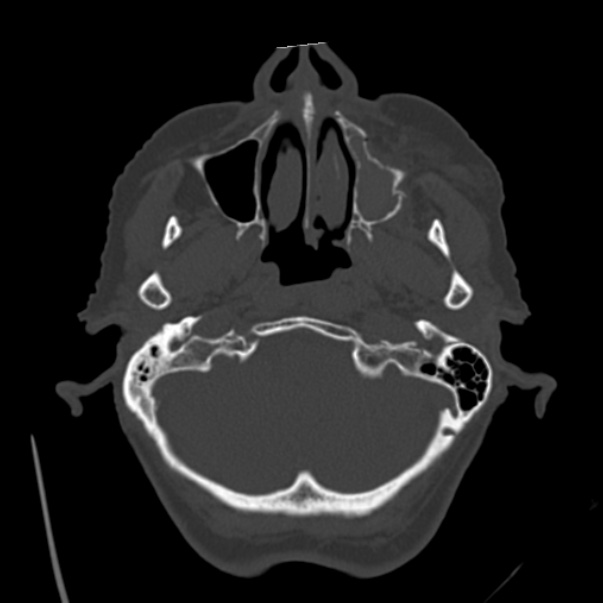 Biparietal osteodystrophy (Radiopaedia 46109-50463 bone window 12).jpg
