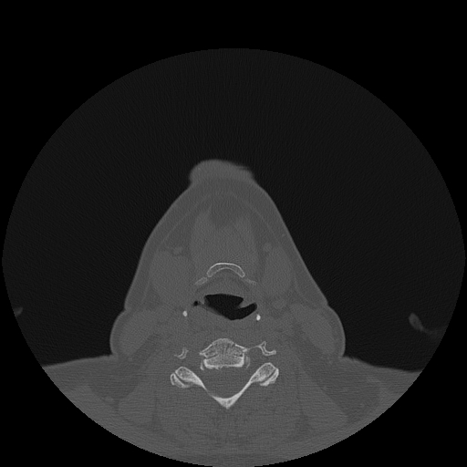 File:Bisphosphonate-related osteonecrosis of the jaw (Radiopaedia 71324-81642 Axial bone window 1).jpg