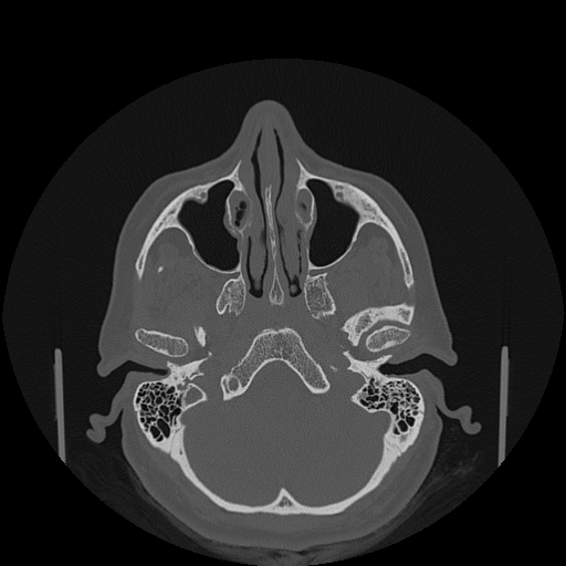 File:Bisphosphonate-related osteonecrosis of the jaw (Radiopaedia 71324-81642 Axial bone window 149).jpg