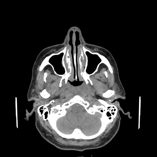 File:Bisphosphonate-related osteonecrosis of the jaw (Radiopaedia 71324-81642 non-contrast 138).jpg