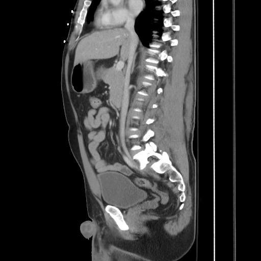 Blunt abdominal trauma with solid organ and musculoskelatal injury with active extravasation (Radiopaedia 68364-77895 C 68).jpg