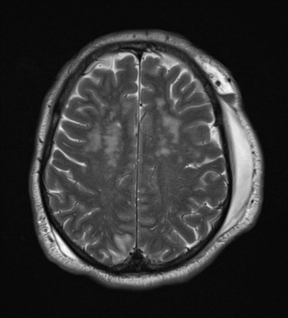 File:Blunt cerebrovascular injury (Radiopaedia 53682-59745 Axial T2 22).png