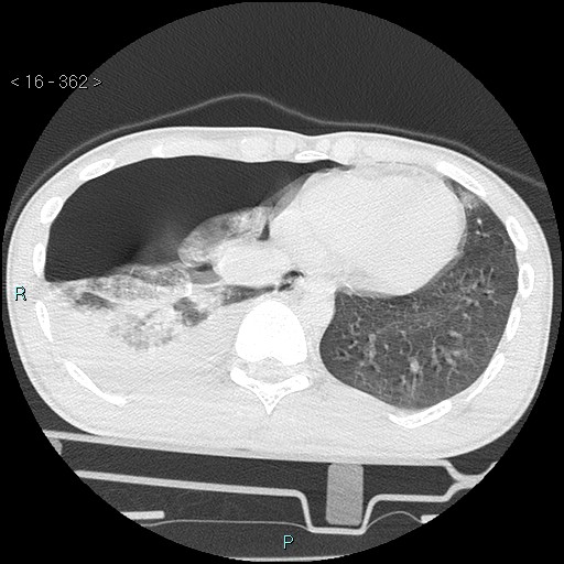 Blunt chest trauma (Swiss cheese sign) (Radiopaedia 38519-40618 Axial lung window 63).jpg
