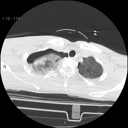 Blunt chest trauma (Swiss cheese sign) (Radiopaedia 38519-40618 Axial lung window 7).jpg