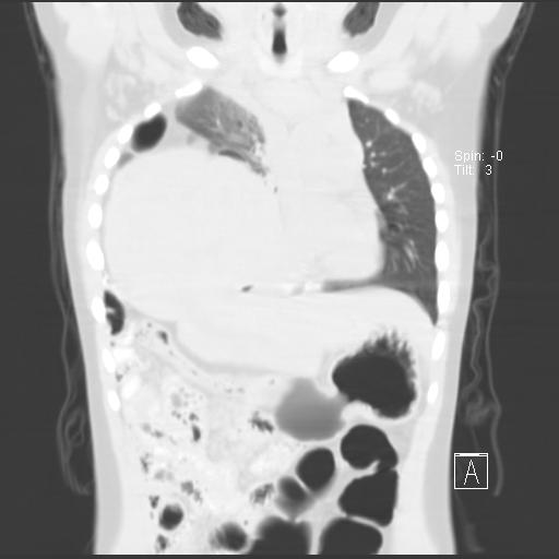 File:Bochdalek diaphragmatic hernia (Radiopaedia 38866-41059 Coronal lung window 9).jpg