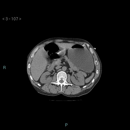 Boerhaave syndrome (Radiopaedia 27683-27897 Axial non-contrast 107).jpg