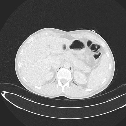 Boerhaave syndrome with mediastinal, axillary, neck and epidural free gas (Radiopaedia 41297-44115 Axial lung window 80).jpg