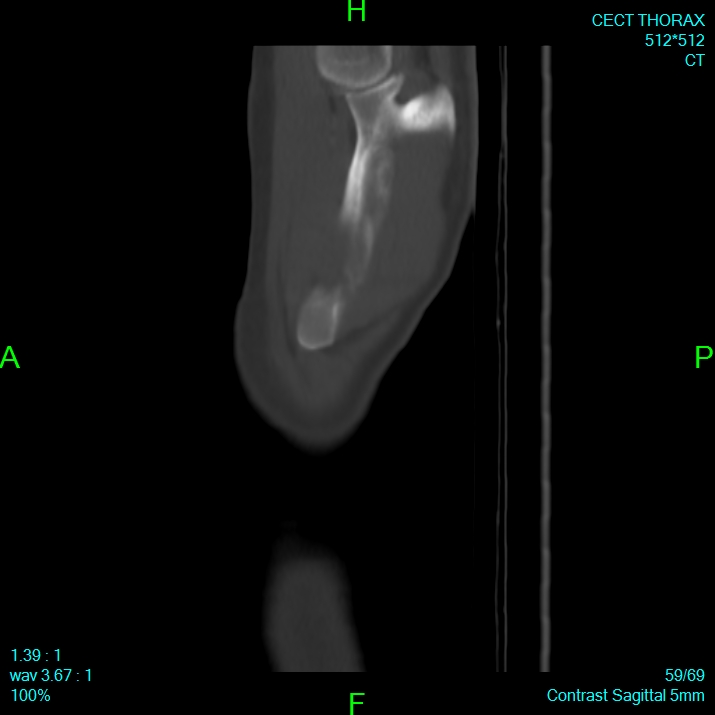 Bone metastases from lung carcinoma (Radiopaedia 54703-60937 Sagittal bone window 59).jpg