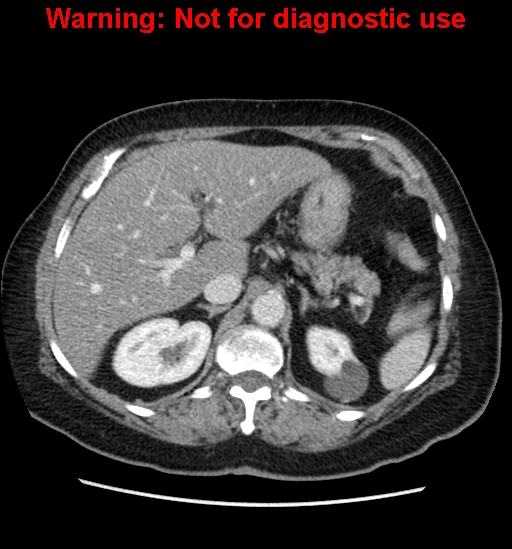 File:Bosniak renal cyst - type II (Radiopaedia 23404-23468 D 19).jpg