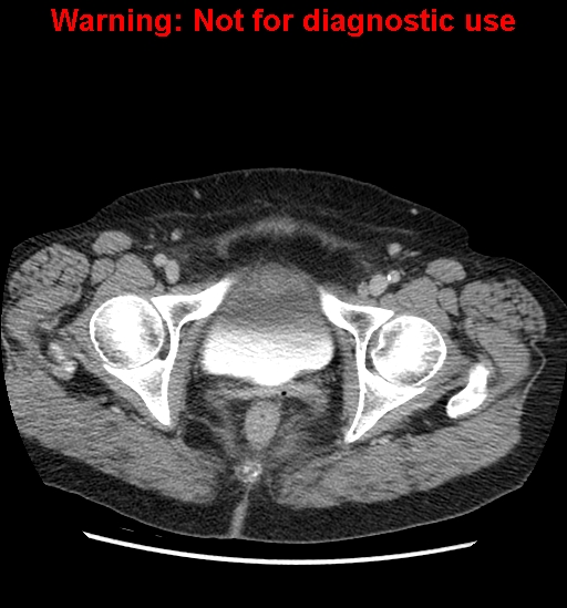 Bosniak renal cyst - type II (Radiopaedia 23404-23468 F 65).jpg