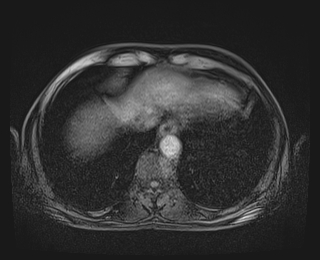 Bouveret syndrome (Radiopaedia 61017-68856 Axial T1 fat sat 6).jpg