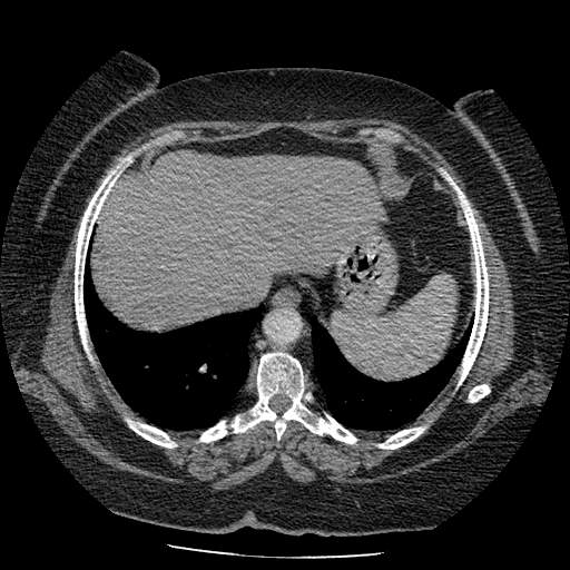 Bovine aortic arch - right internal mammary vein drains into the superior vena cava (Radiopaedia 63296-71875 A 136).jpg