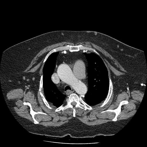 Bovine aortic arch - right internal mammary vein drains into the superior vena cava (Radiopaedia 63296-71875 A 40).jpg