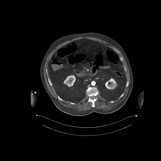File:Bowel ischemia secondary to SMA occlusion with extensive portomesenteric venous gas (Radiopaedia 54656-60871 A 45).jpg