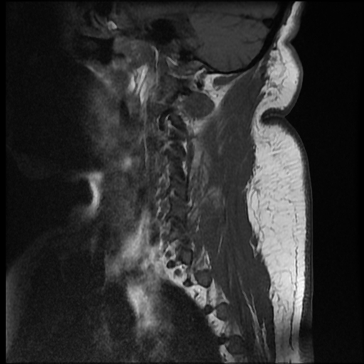 File:Brachial plexopathy (Radiopaedia 21844-21806 Sagittal T1 11).jpg