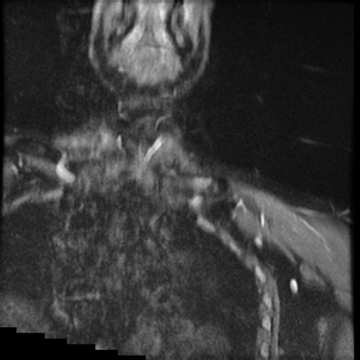 File:Brachial plexus neurofibroma (Radiopaedia 28030-28291 Coronal STIR 16).png