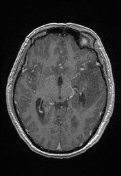 Brain abscess with ventriculitis (Radiopaedia 85703-101495 Axial T1 C+ 83).jpg