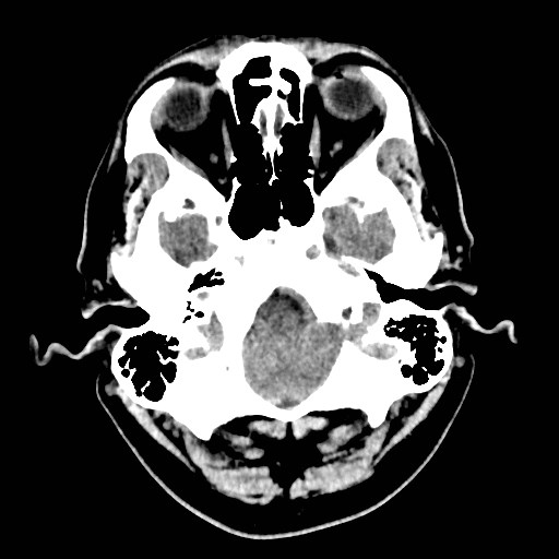 File:Brain metastases from lung cancer (Radiopaedia 83839-99027 Axial non-contrast 5).jpg