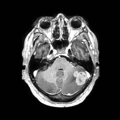 File:Brain metastases from lung cancer (Radiopaedia 83839-99028 Axial T1 C+ 13).jpg