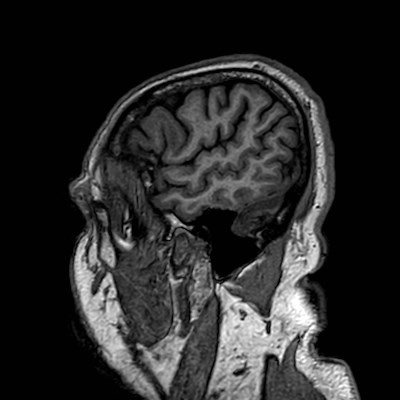 Brain metastases from lung cancer (Radiopaedia 83839-99028 Sagittal T1 15).jpg