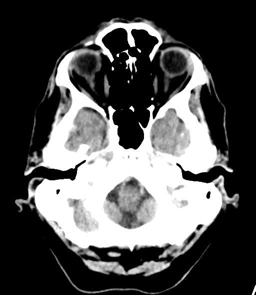 File:Brain metastasis (lung cancer) (Radiopaedia 48289-53177 Axial non-contrast 4).png