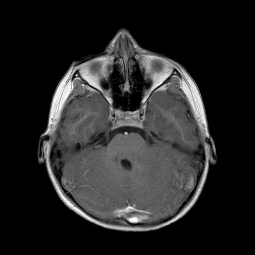 File:Brainstem ganglioglioma (Radiopaedia 10763-11224 Axial T1 C+ 8).jpg