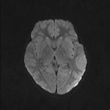 Brainstem glioma (Radiopaedia 67531-76922 Axial DWI 36).jpg