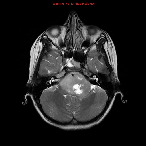 File:Brainstem glioma (Radiopaedia 9444-10124 Axial T2 5).jpg