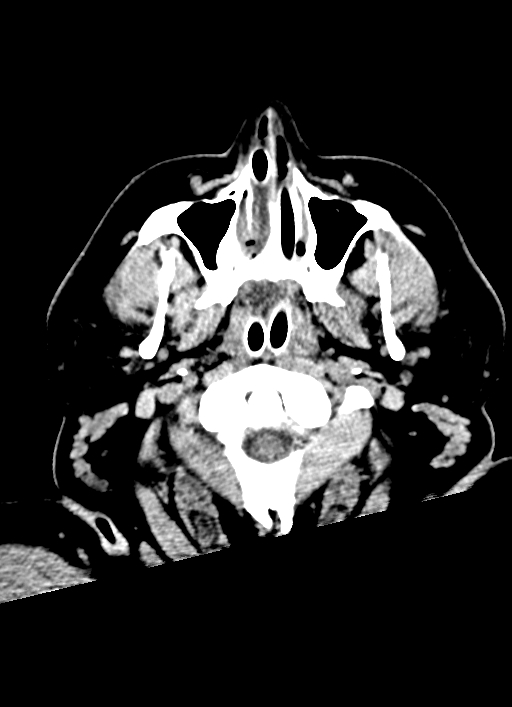 Brainstem hemorrhage (Radiopaedia 81294-94976 Axial non-contrast 65).jpg