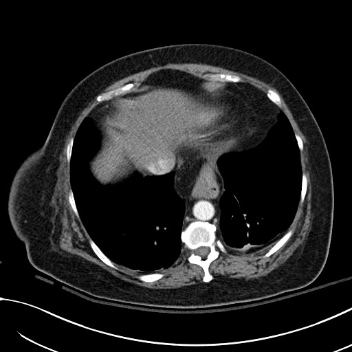 File:Breast carcinoma with pathological hip fracture (Radiopaedia 60314-67974 A 42).jpg