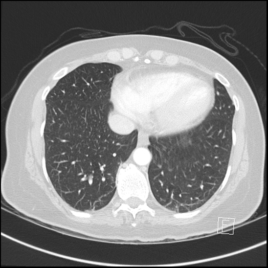 Breast metastases from renal cell cancer (Radiopaedia 79220-92225 Axial lung window 65).jpg