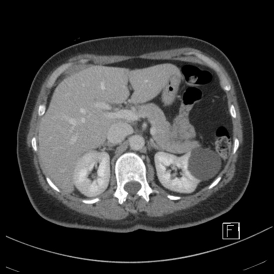 Breast metastases from renal cell cancer (Radiopaedia 79220-92225 C 27).jpg