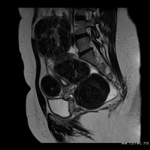 File:Broad ligament fibroid (Radiopaedia 49135-54241 Sagittal T2 11).jpg