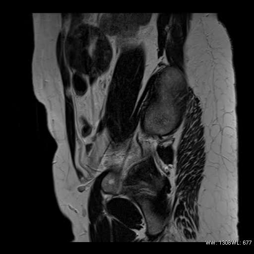 File:Broad ligament fibroid (Radiopaedia 49135-54241 Sagittal T2 23).jpg