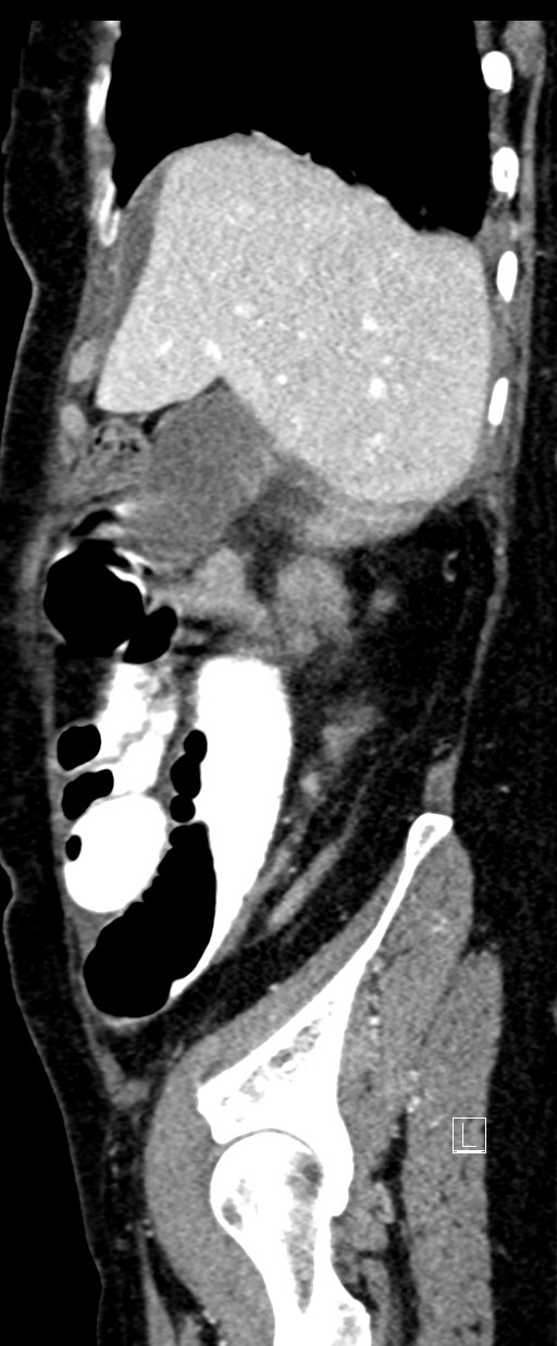 Broad ligament hernia (Radiopaedia 84802-100276 C 67).jpg