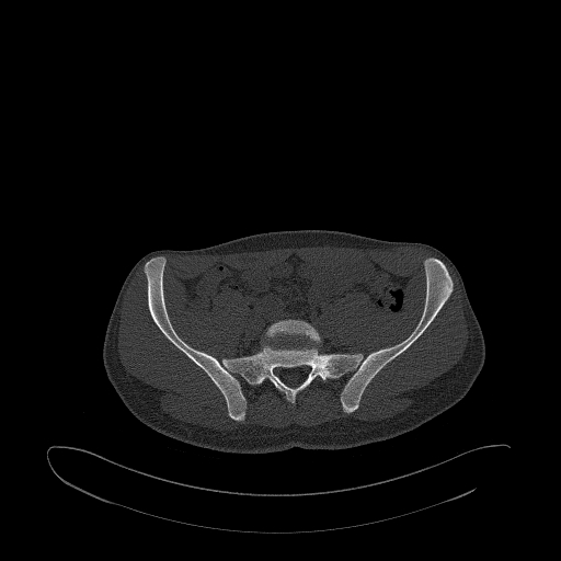 Brodie abscess- femoral neck (Radiopaedia 53862-59966 Axial bone window 30).jpg