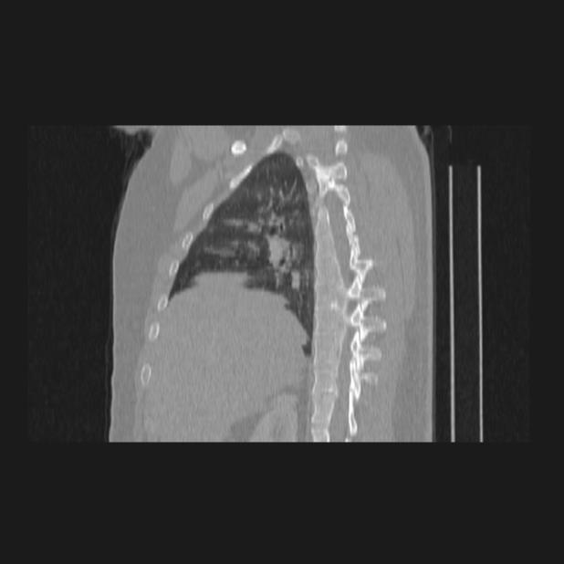 Bronchial atresia (Radiopaedia 60685-68439 Sagittal lung window 29).jpg