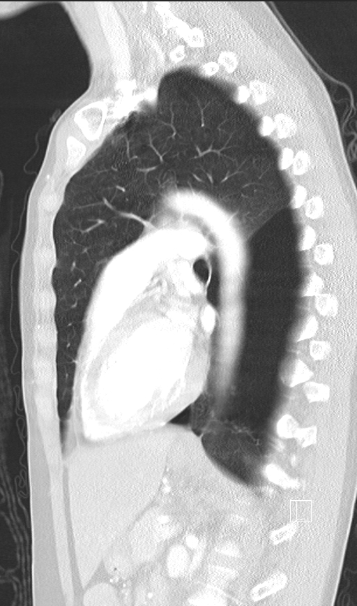 Bronchial atresia (Radiopaedia 73677-84470 Sagittal lung window 32).jpg