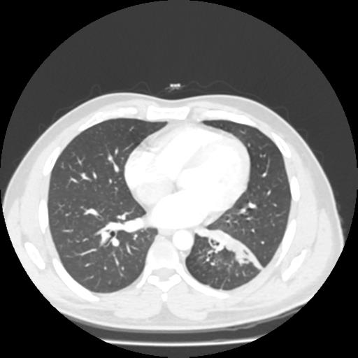 Bronchial carcinoid (Radiopaedia 80013-93291 Axial lung window 76).jpg