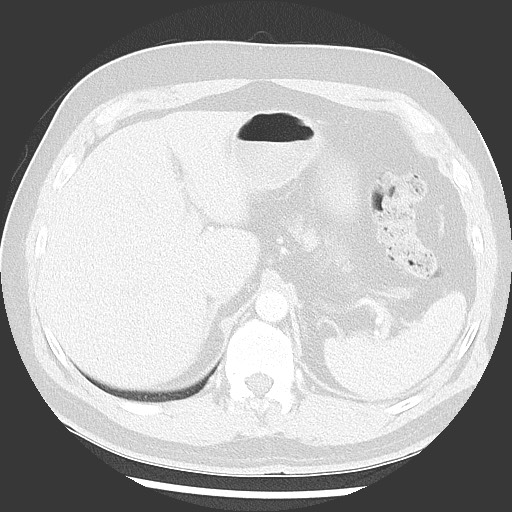 Bronchial carcinoid tumor (Radiopaedia 67377-76764 Axial lung window 59).jpg