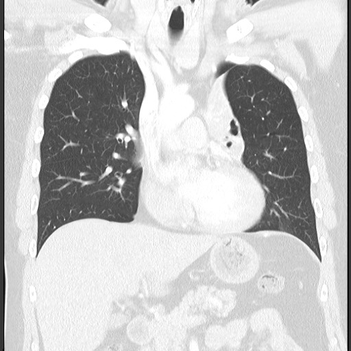 Bronchial carcinoid tumor (Radiopaedia 67377-76764 Coronal lung window 32).jpg