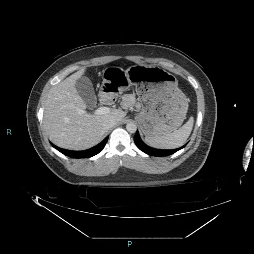 Bronchial carcinoid tumor (Radiopaedia 78272-90870 C 117).jpg
